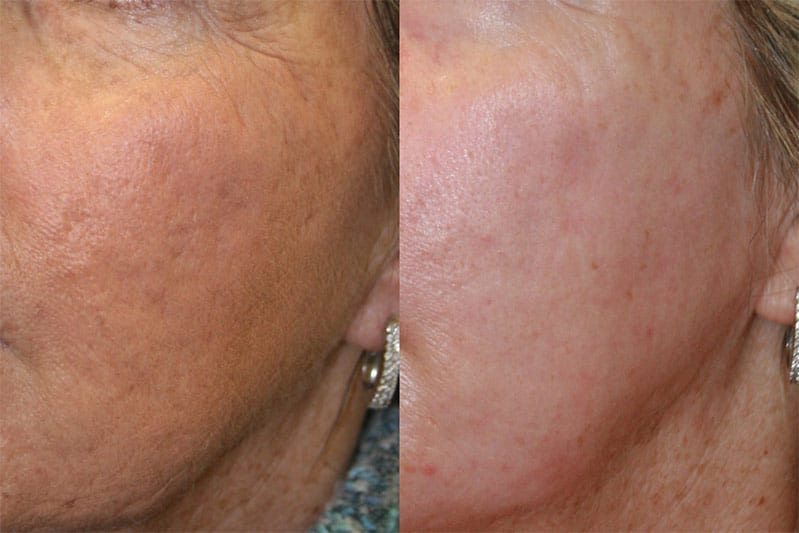 Before and After Image