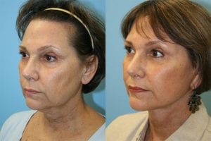 Before and After Image