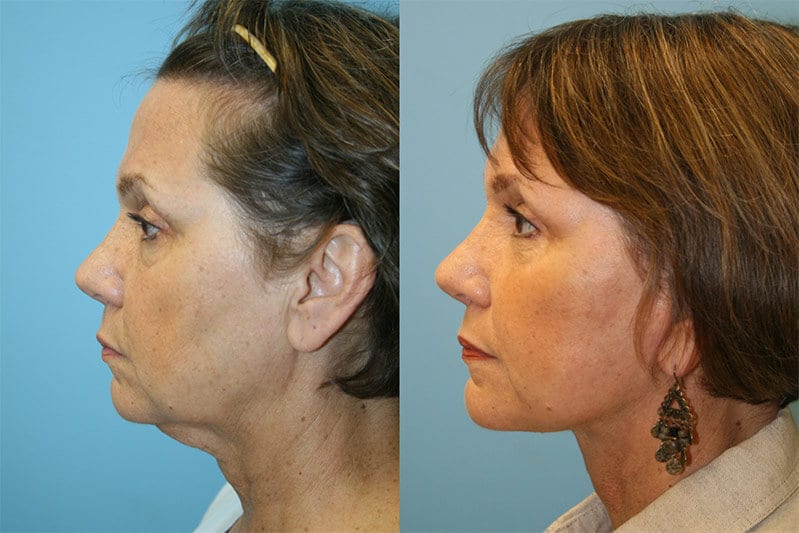 Facelift 01 Fox Facial Plastic Surgery Center
