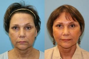 Before and After Image