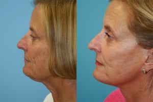 Before and After Image