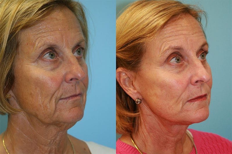 Before and After Image