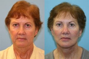 Before and After Image