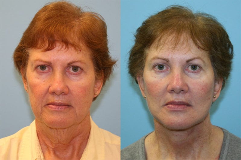 Before and After Image