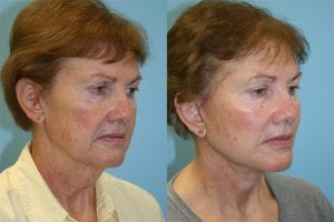 Before and After Image