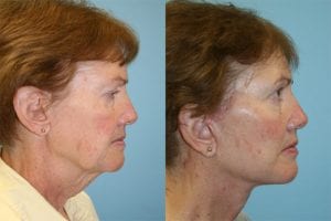 Before and After Image