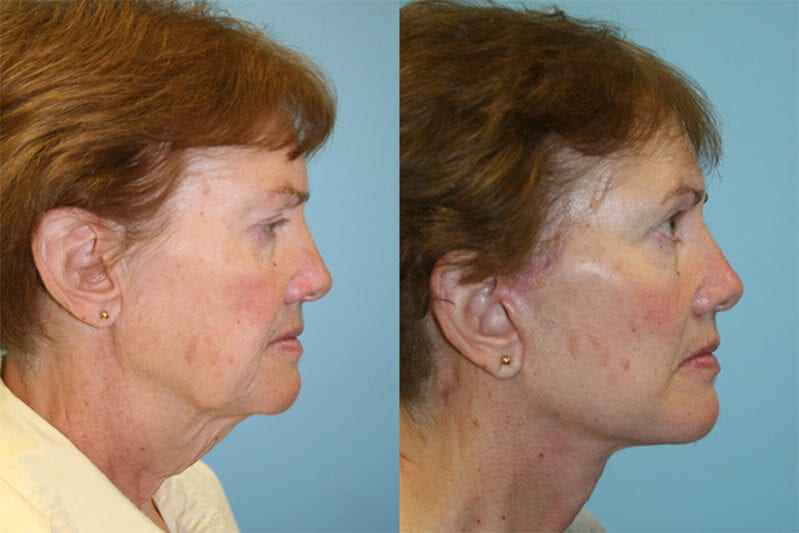 Before and After Image