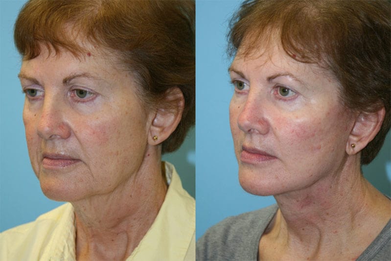 Before and After Image