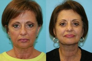 Before and After Image