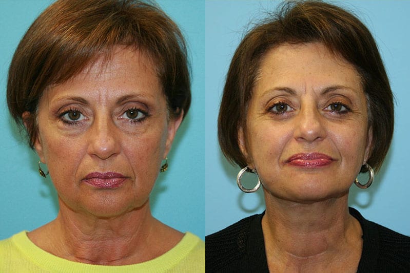 Before and After Image