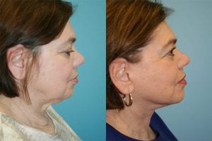 Before and After Image