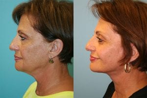 Before and After Image