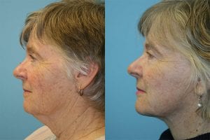 Before and After Image