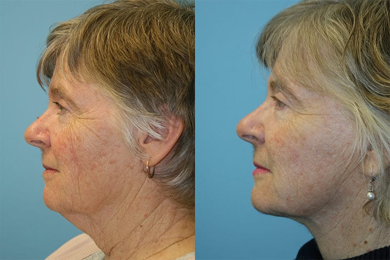 Before and After Image