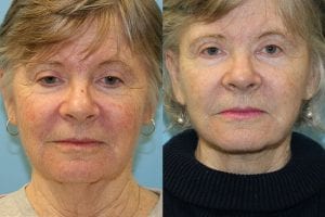 Before and After Image