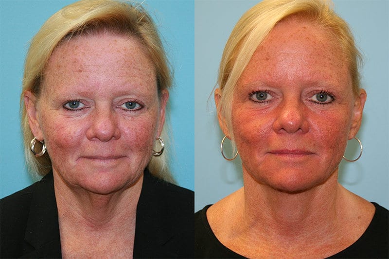 Before and After Image