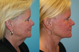 Before and After Image