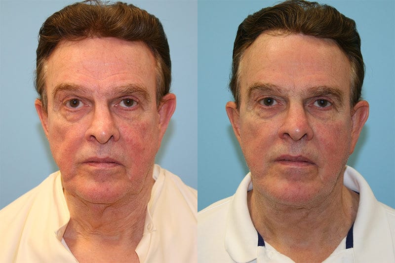 Before and After Image