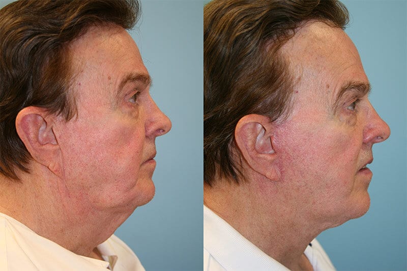 Before and After Image