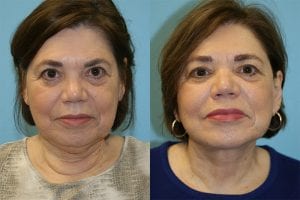 Before and After Image