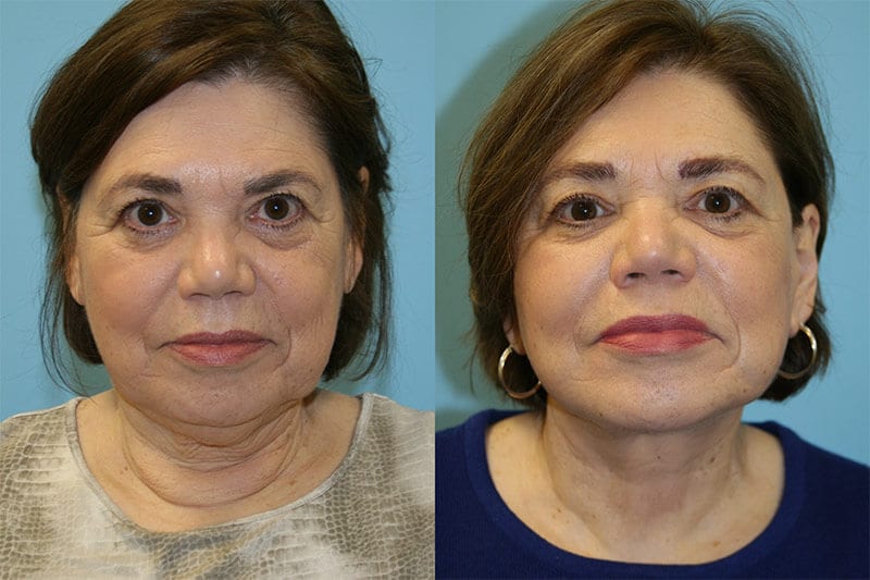 Before and After Image