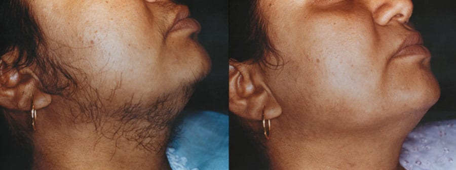 Laser Hair Removal 02 - Fox Facial Plastic Surgery Center