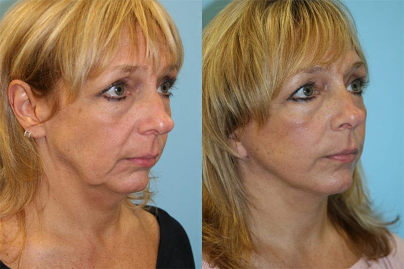 Before and After Image