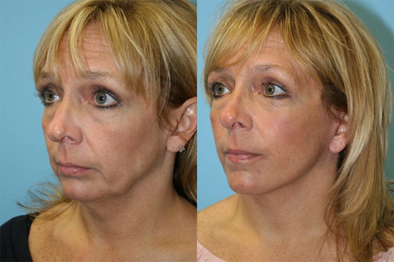 Mini Lift 01 Fox Facial Plastic Surgery Center