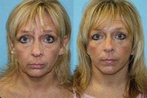 Before and After Image