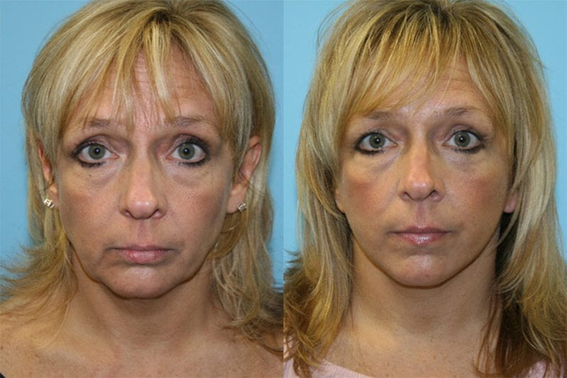 Before and After Image