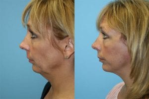 Before and After Image