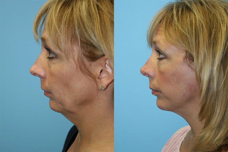 Before and After Image