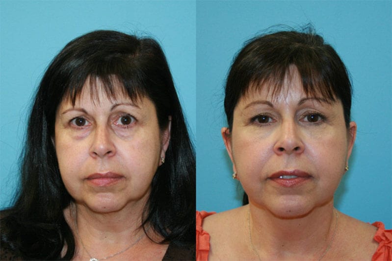 Before and After Image