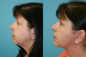 Before and After Image