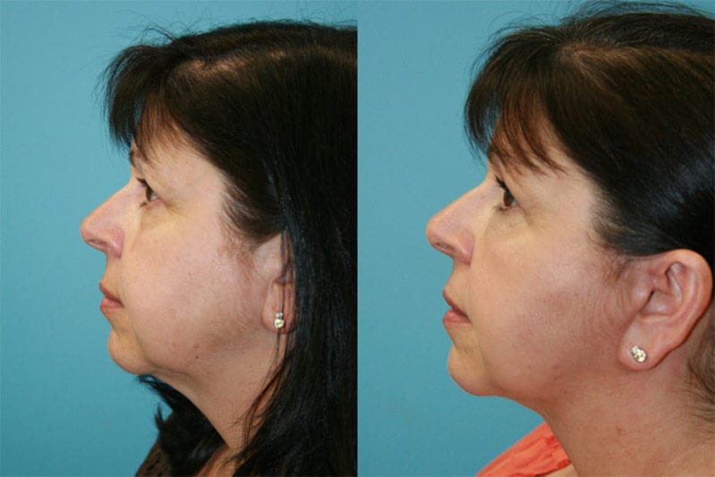 Before and After Image