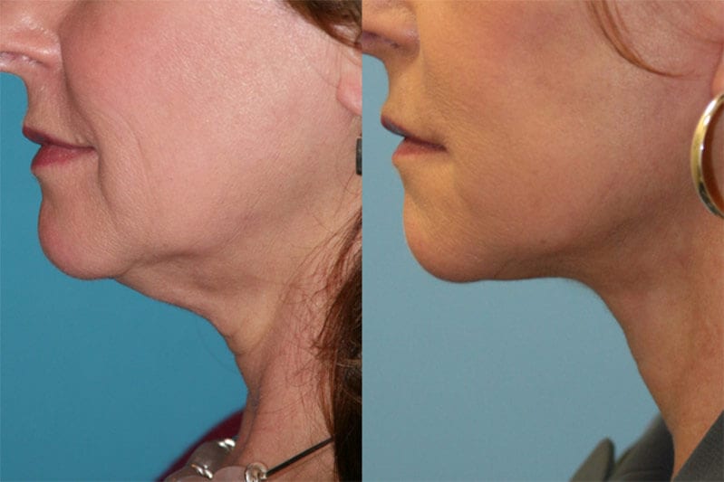 Before and After Image