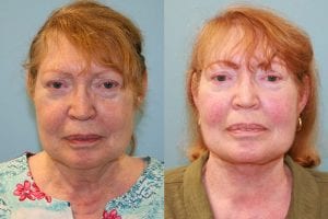 Before and After Image