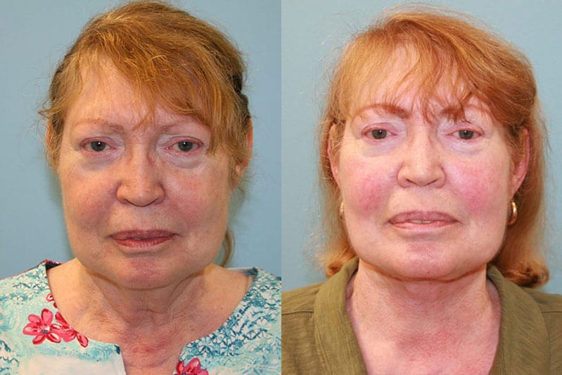 Before and After Image