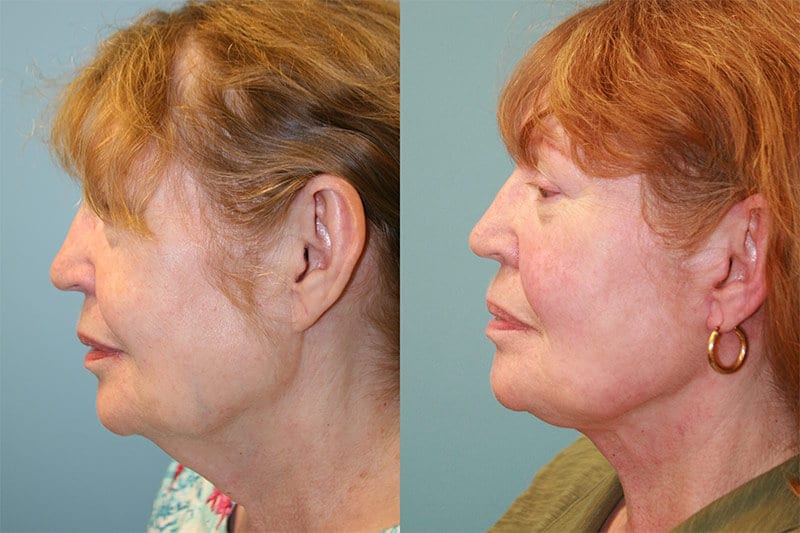 Before and After Image