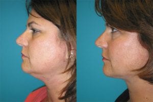 Before and After Image