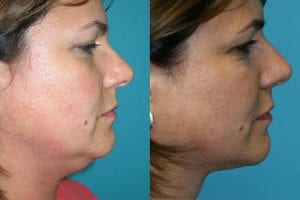 Before and After Image