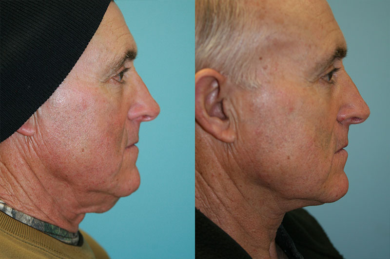 Before and After Image