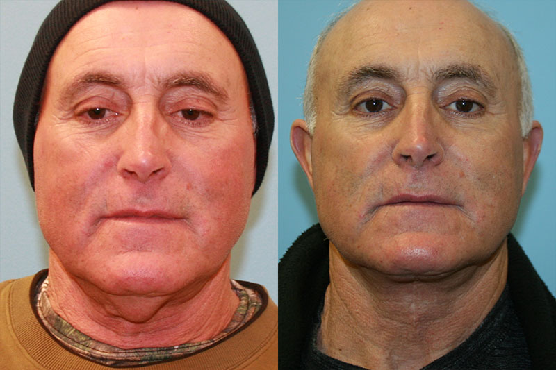 Before and After Image