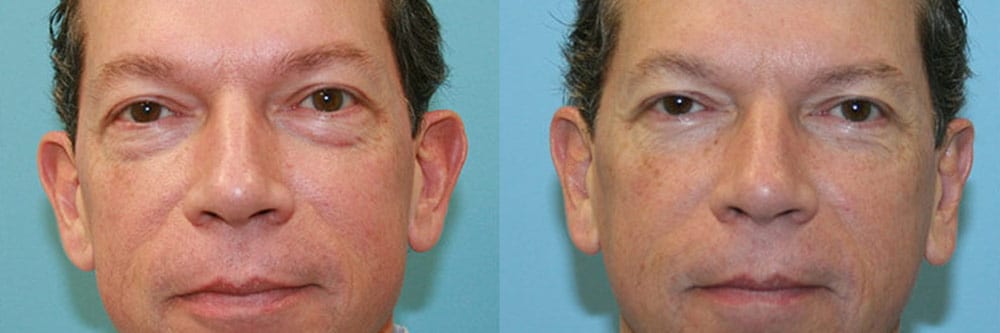 Before and After Image