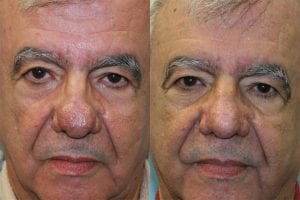 Before and After Image