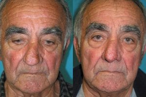 Before and After Image