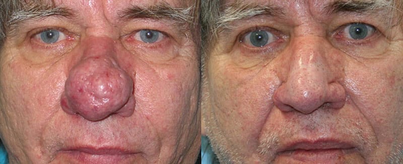 Rhinophyma Archives Fox Facial Plastic Surgery Center