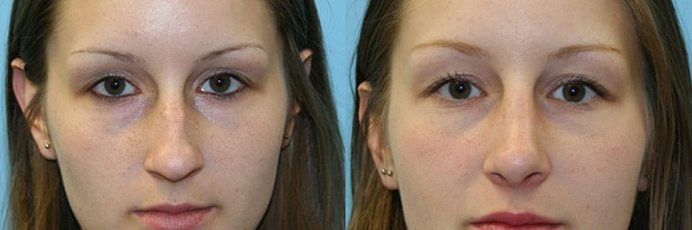 Before and After Image