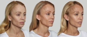 Before and After Image