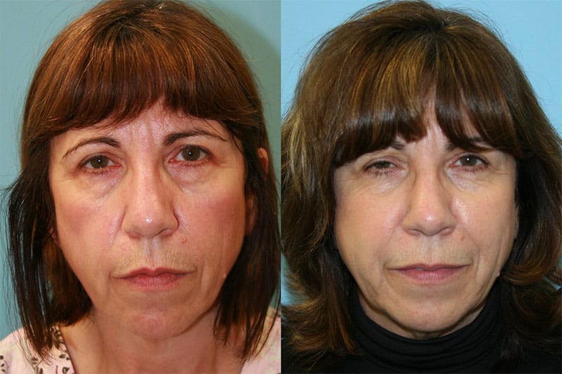 Before and After Image